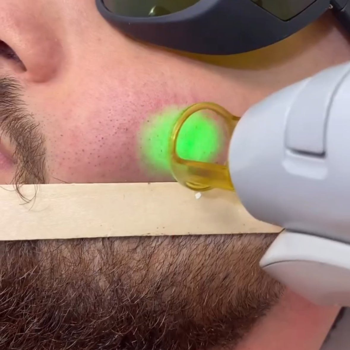 Laserontharing Heren Losse Behandelingen